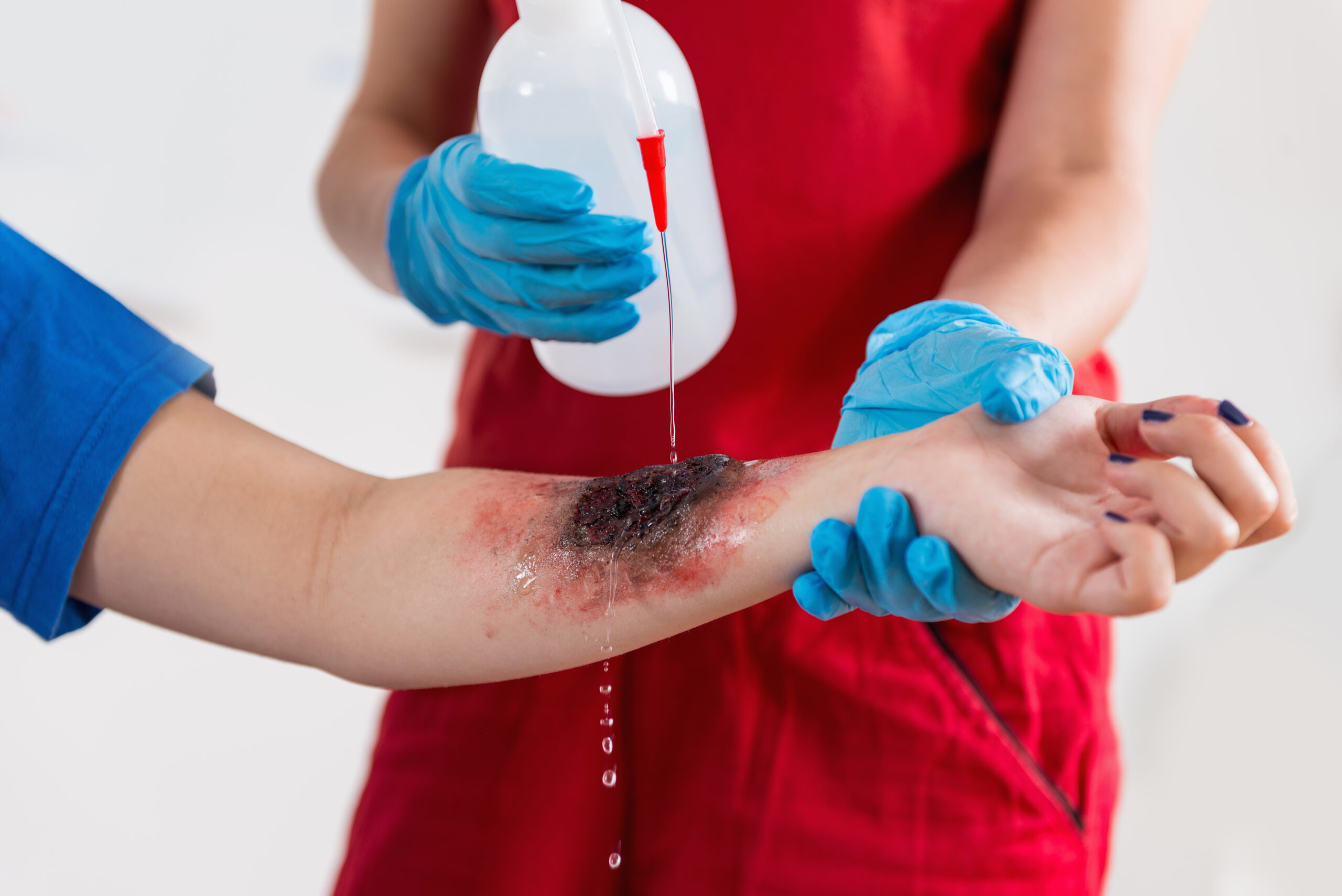 First Aid Training Burn injury First Aid Training Burn injury